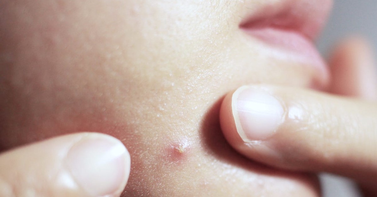 What's in a zit? How pimples form and what different acne types are ...