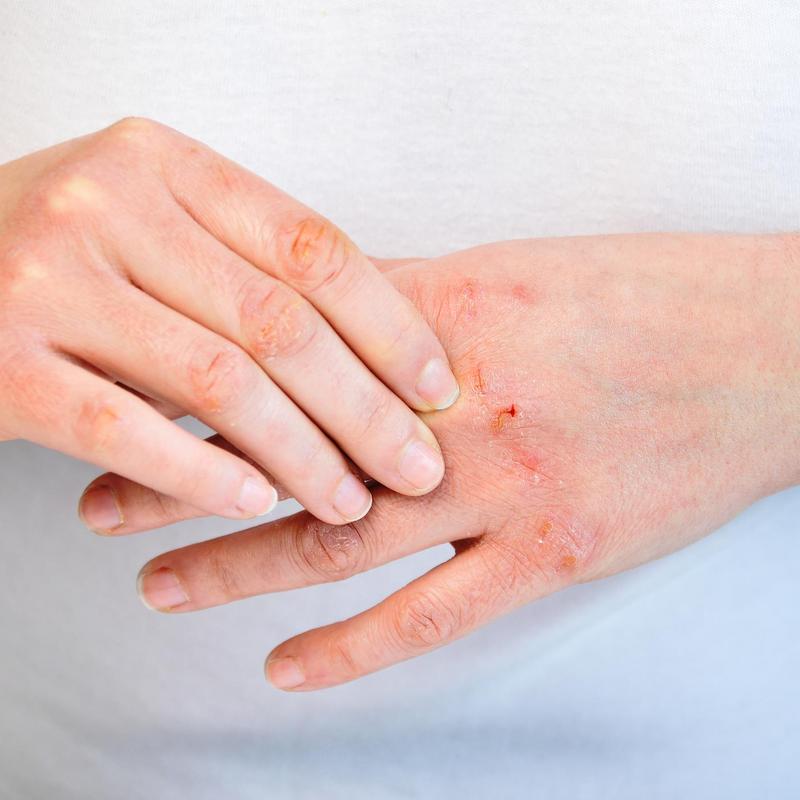 Alergia kontaktowa na twarzy i dłoniach - objawy i leczenie