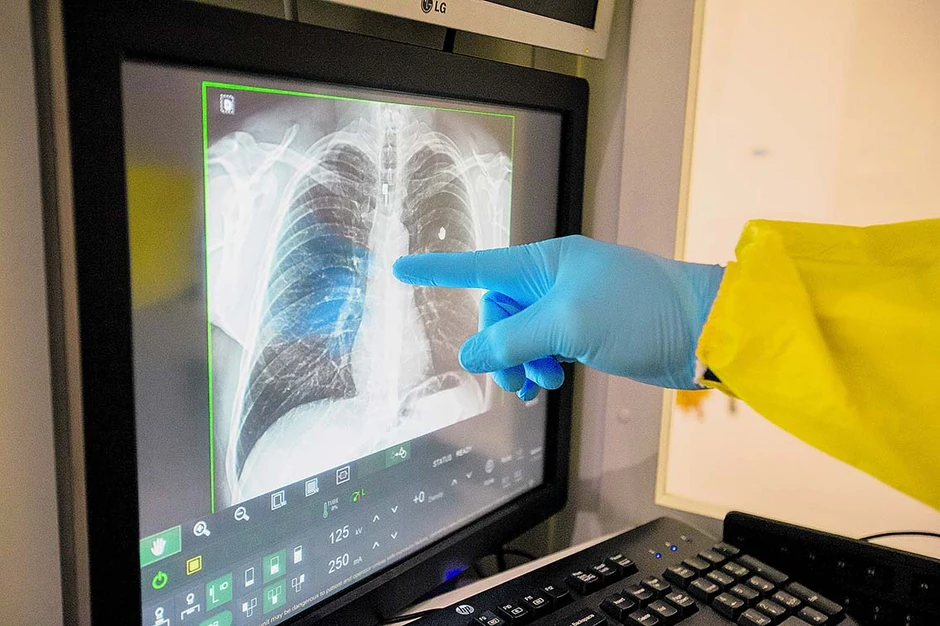 Nepravilan rad srca otkriven je kod 78 odsto obolelih od Covid-19 koji su pregledani desetak nedelja nakon infekcije