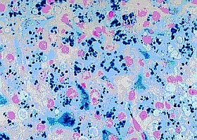 hemokromatozis-d00001338282e9a2ef2c9