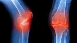 Osteoartritis - curso, causas, síntomas.  ¿Cómo tratamos los cambios óseos degenerativos?