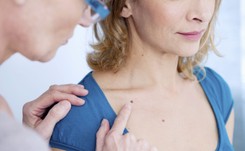 Jak ustrzec się przed czerniakiem? Proste zasady profilaktyki