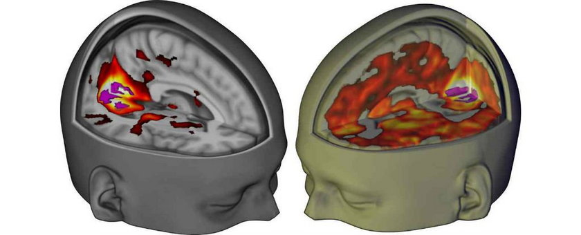 Porównanie mózgu po zażyciu LSD i placebo