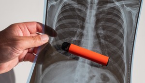 Kokičasta pluća najčešće nastaju kod korisnika koji se izlažu određenim hemikalijama