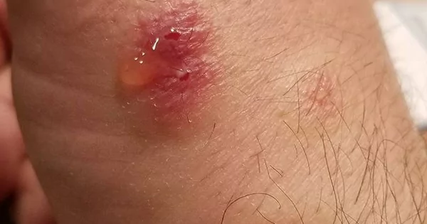 spider bite rash