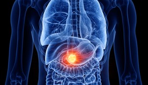 ilustracija za rak jetre