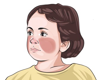 Skarlát-arcpír: a kipirosodás száj körüli sápadtsággal társul.