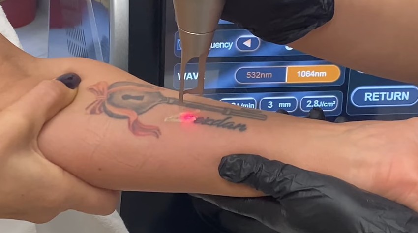 Ana Ćurčić uklonila tetovažu koju je posvetila Zvezdanu Slavniću