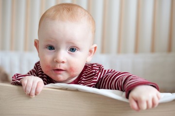 Az egész gyermekkort tönkre teheti ez a félreértett bőrbetegség!