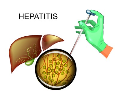 Ingyenes Hepatitis C szűrés országszerte: ezek a helyszínek