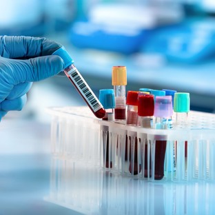 Ez az antitest már évekkel előre jelezheti a sclerosis multiplex kockázatát