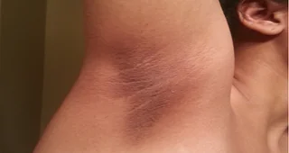 3 Quick Ways To Get Rid Of Armpit Lumps Pulse Nigeria