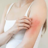 Tusfürdő, mosópor vagy étel okozza a kiütéseit? Ez segíthet eldönteni