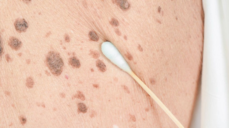 májfolt oka bőrön hormonális betegség tünete