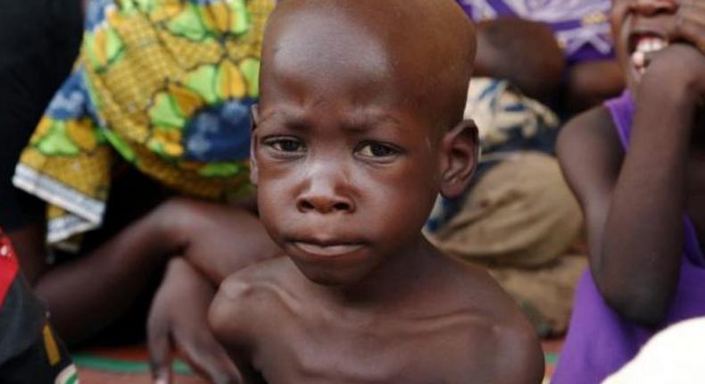 Malnutrition of children under five, worsens — UNICEF