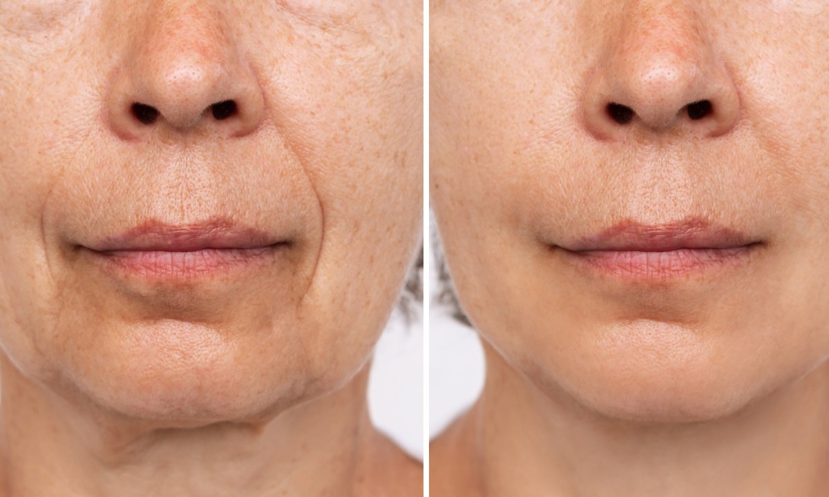 To japońskie serum do twarzy działa jak lifting bez skalpela! Likwiduje zmarszczki marionetki