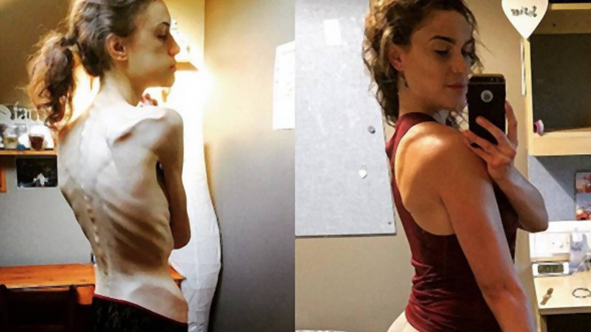 Pred rokom umierala, dnes bývalá anorektička vďačí Instagramu za záchranu svojho života