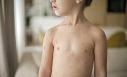 Odra wraca tam, gdzie została wyeliminowana. Ostrzeżenie WHO