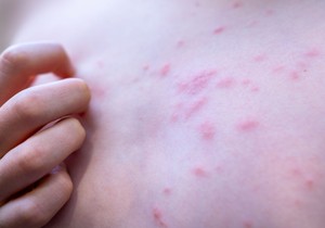 Stopala su posebno izložena ujedima ovih buba jerdolaze u direktan kontakt sa peskom, kamenjem, školjkama, insektima i morskom vodom