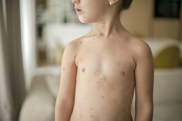 Bárányhimlő: súlyosak is lehetnek a szövődmények