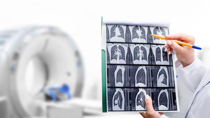 tüdőrákszűrés daganat diagnózis CT