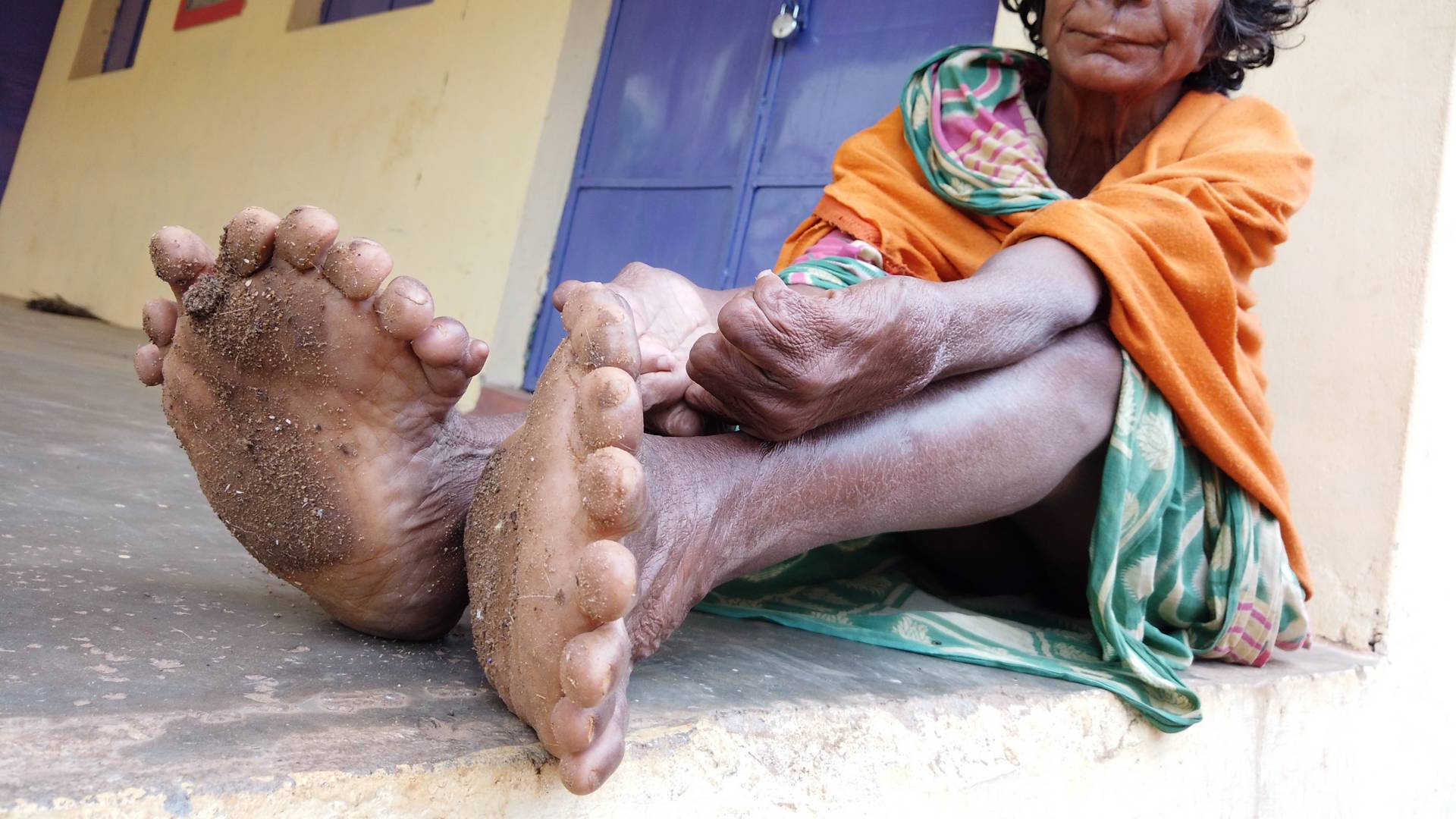 31 ujjal született egy indiai nő, akit emiatt most boszorkánynak hisznek a helyiek
