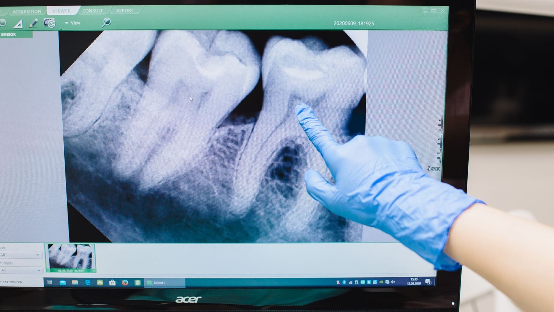 Implant dentar cu adiție de os: când e nevoie și cât costă