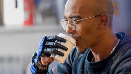 Ali kezét 6 évesen megcsonkította a húsdaráló, most ő lett a világon az első, aki 3D-s nyomtatású ujjakat kapott – fotók