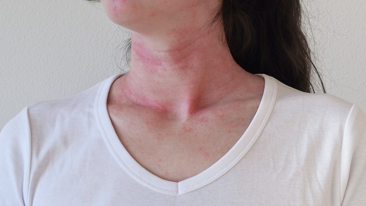 anafilaxia, allergia, reakció, tünet