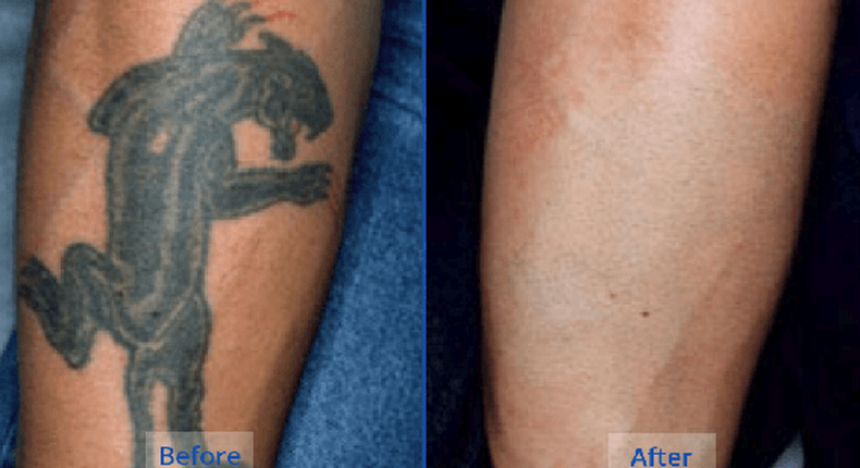 5 natural tattoo removal remedies you can try at home