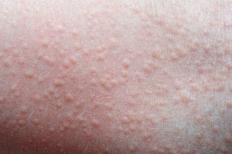 here-are-rashes-that-could-occur-during-pregnancy-second-trimester