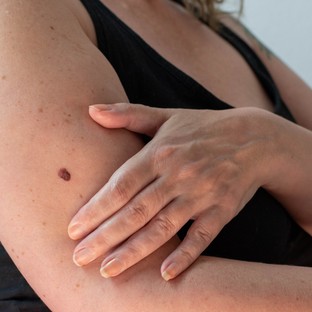 Bőrrák-megelőző állapot: a bőrgyógyász szerint erről ismerhető fel