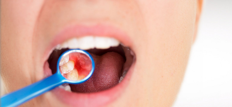 5 sytuacji, kiedy ząb trzeba usunąć