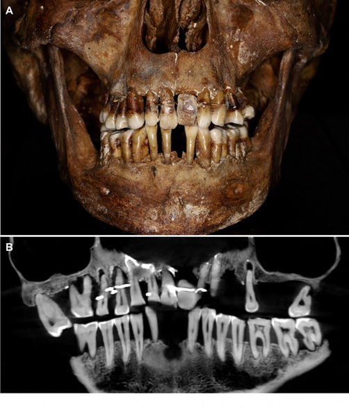 Zęby Anne d’Alègre, XVII-wiecznej arystokratki, Institut National de Recherches Archéologiques Préventives (INRAP)
