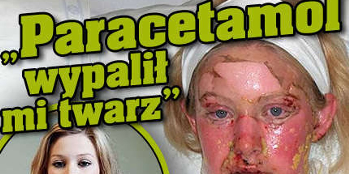 "Paracetamol wypalił mi twarz"