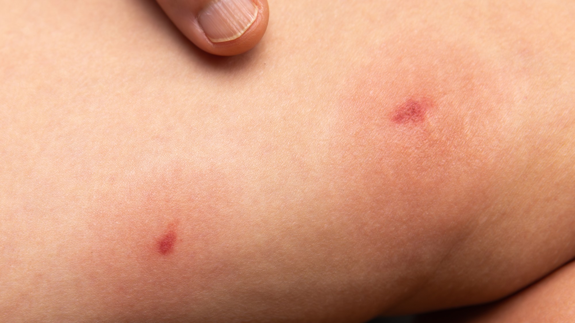 Sú maličké, tiché a vyzerajú nevinne. Uhryznutie muchničiek môže spôsobiť až 10-centimetrový opuch