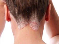 10 pytań o łuszczycę. Wszystko, co trzeba wiedzieć o chorobie