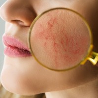Rosacea - ezzel az 5 dologgal vigyázzon, ha érinti a probléma