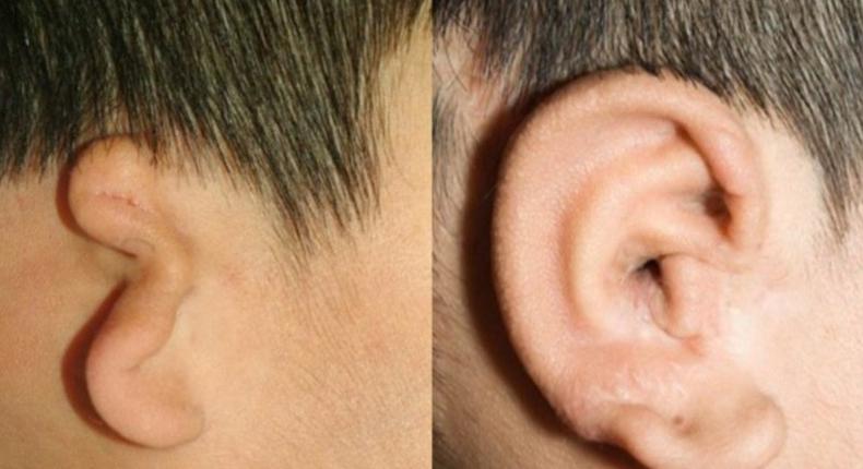 An under-developed ear replaced with a 3D printed ear