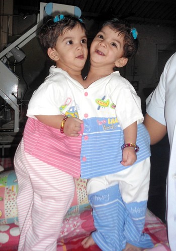 Bliźniaczki syjamskie - Aradhana i Stuti