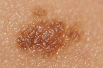 melanoma , melanoma malignum, bőrrák, bőrdaganat, daganattípus