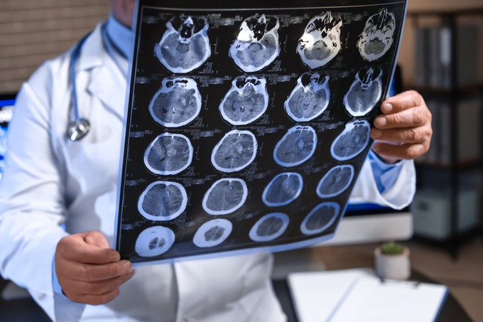 Nem javasolják az EU-ban az Alzheimer-kór elleni gyógyszer forgalomba hozatalát