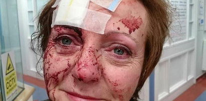 50-latka brutalnie pobita w urodziny. Wstrząsające zdjęcia!