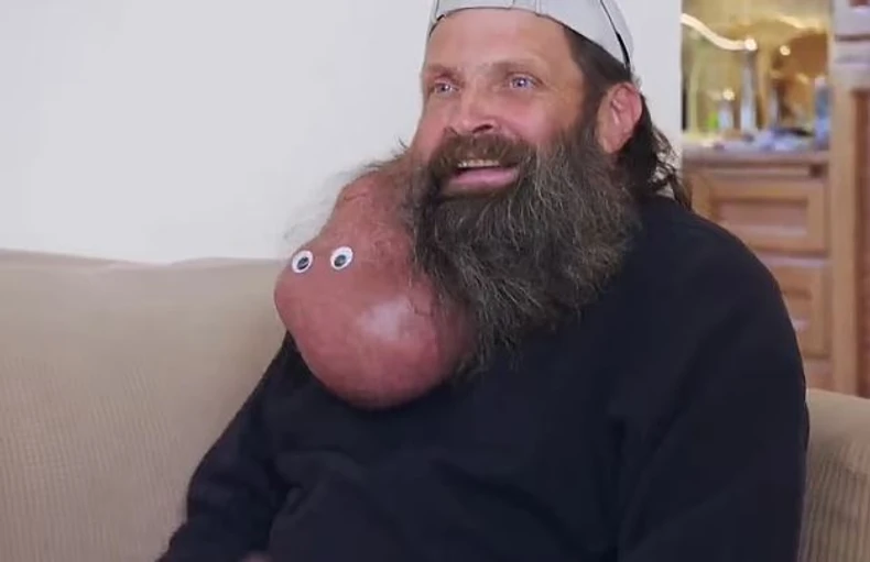 Tumor koji je Tim imao godinama na licu