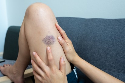 Ízületi fájdalom, kiütések, véraláfutások: ezekkel is jelezhet a leukémia