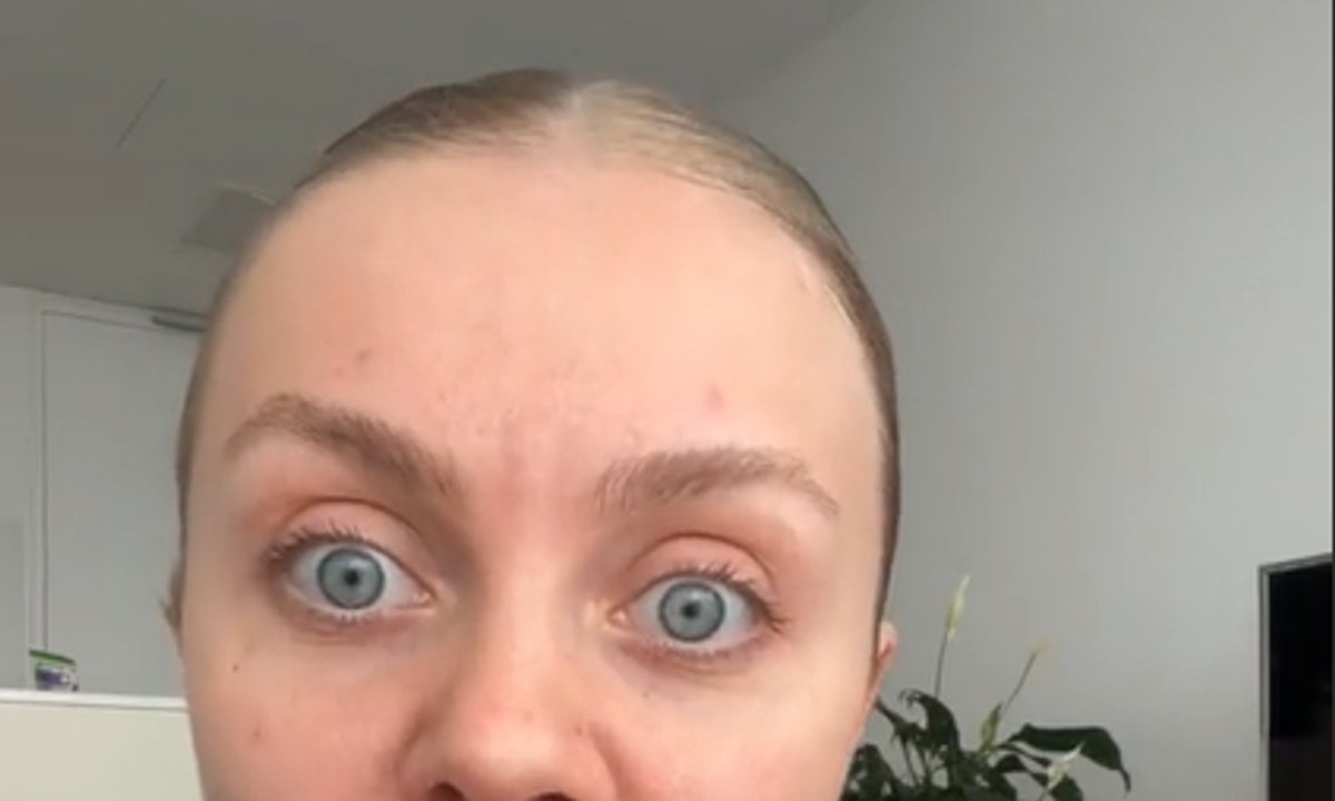 Wycisnęła pryszcza, którego miała rok. Pokazała, co stało się z jej twarzą