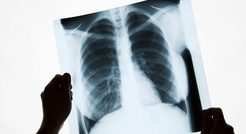 This Is Why Men Need to Be Screened For Lung Cancer More Than Women