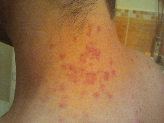 Pasażer pogryziony przez pluskwy w PKP