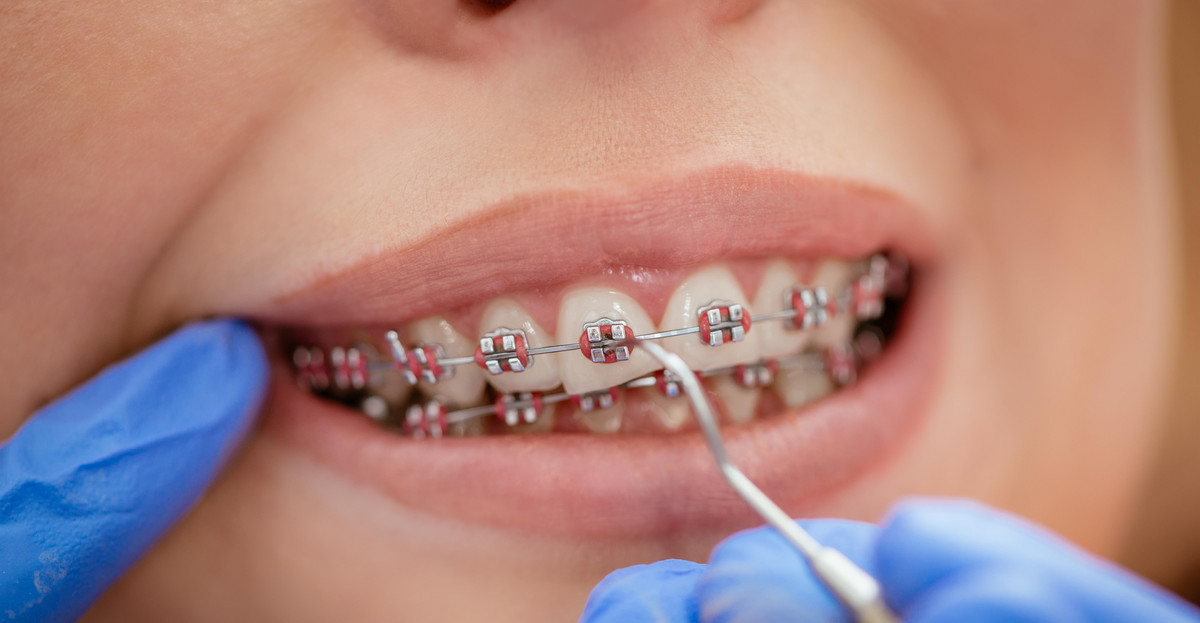 Stałe aparaty ortodontyczne to jedna ze skuteczniejszych metod leczenia wad zgryzu