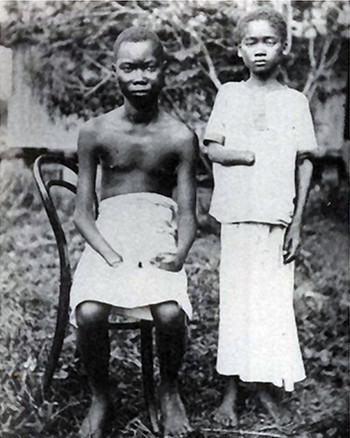 Amputacja kończyn była powszechną karą w Kongo rządzonym przez belgijskiego króla Leopolda II